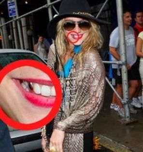 Ke$ha si-a pus dinte de aur